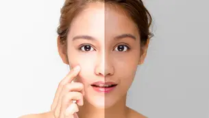 laser skin whitening