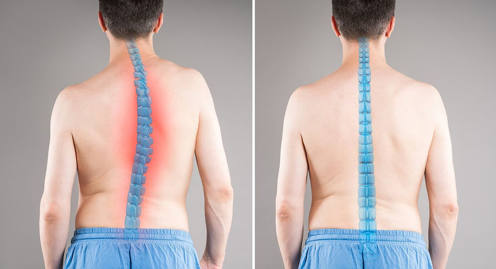 Man-before-and-after-spine-curvature-correction-scoliosis-treatment-comparison.jpg