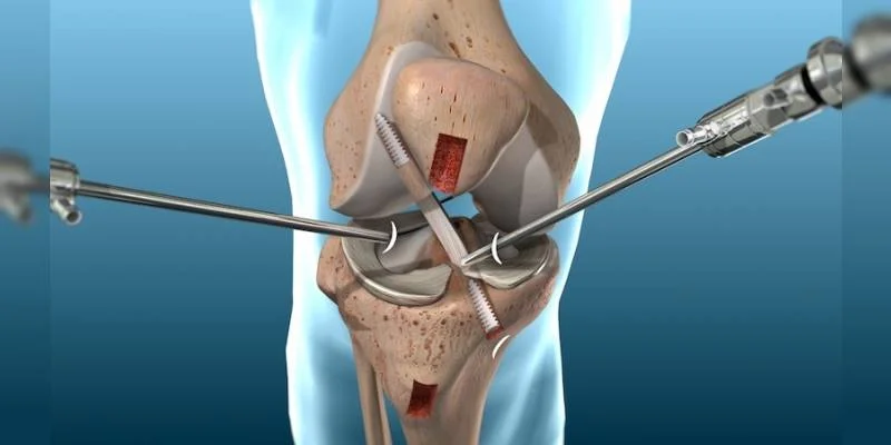 Arthroscopic Surgeries