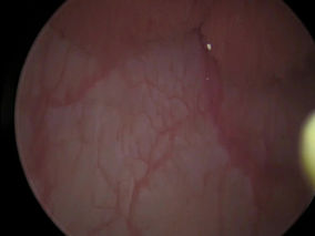 Wellington Urology news: how we've improved our treatment of bladder tumours