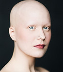 Alopecia Universalis.jpg