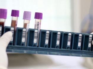 Ceará já conta com pontos de coleta para exame genético de doenças raras no SUS