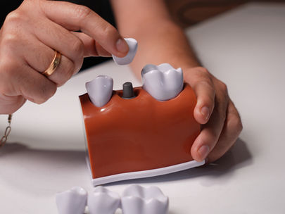 Dental Implants: The Definitive Solution to Restore Your Smile