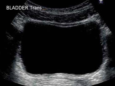 Bladder Ultrasound-Picture Perfect Ultrasound