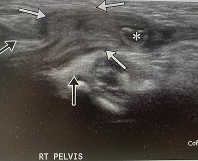 Hernia Ultrasound-groin-Picture Perfect Ultrasound