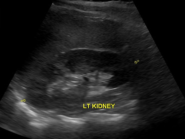 Kidney-renal Ultrasound-Picture Perfect Ultrasound