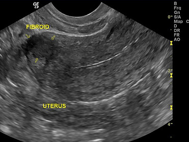 Fibroid-Uterus Ultrasound-Picture Perfect Ultrasound