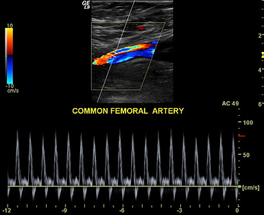 Artery Ultrasound_Picture Perfect Ultrasound