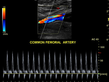 Femoral Artery Ultrasound-Picture Perfect Ultrasound