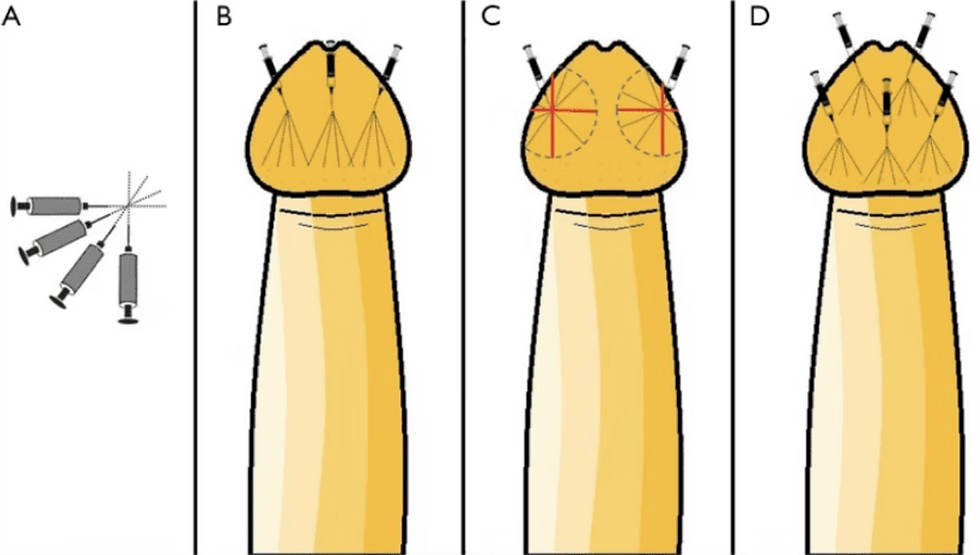 Injection techniques for premature ejaculation treatment