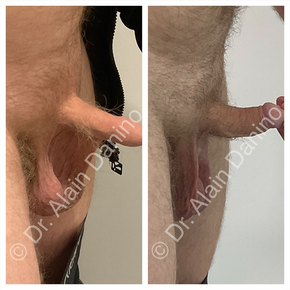 Before and after scrotal webbing surgery by Dr. Alain Danino
