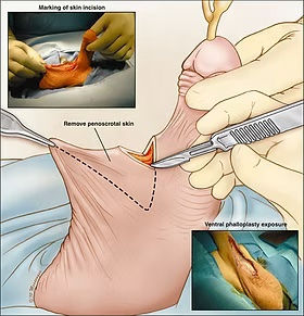 Surgical diagram of scrotal webbing repair procedure.