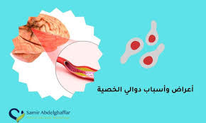 اعراض واسباب دوالي الخصية