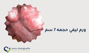 ورم ليفي حجمه 7 سم