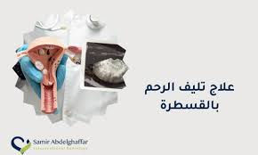 علاج تليف الرحم بالقسطرة