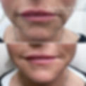 marionettes Cheek dermal filler,  Lip filler Romsey, totton, southampton, Winchester, Hedge end, hice, Hampshire, Warminster,Trowbridge, Westbury, Devizes, Hilperton, Wiltshire, Corsham