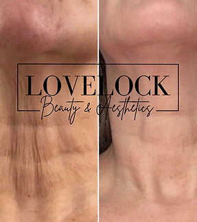 Fibroblast Skin tightening trowbridge, melkshaam, devizes, frome, chippenham, romesy, totton, southampton, winchester, wiltshire, southampton, corsham