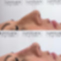 Nose filler, rhinoplasty, Romsey, Totton, southampton, winchester, hampshire, Westbury, Warminster, Westbury, Trowbridge, Hilperton, Devizes, Frome, Melksham Dermal filler