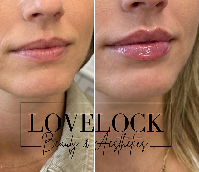 Lip filler trowbridge Melksham Wiltshire