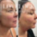jawline scultpyin, dermal filler, Romsey, totton, southampton, winchester, hampshire. Trowbridge, westbury, Melksham, Chippenham, Hilperton, Fillers wiltshire