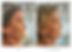Resultaat NBE3000 behandeling.png