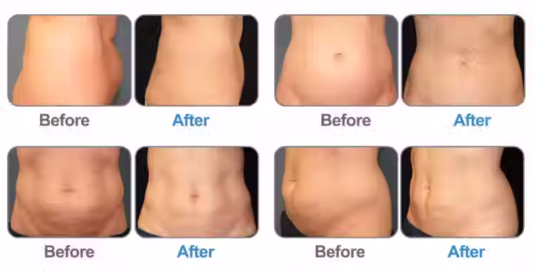 Thumbnail: Beauty Equipment Cool Vacuum 360 Fat Freezing Machine Cryolipolysis Slimming