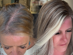 Who Should Seek Out Non-Surgical Hair Replacement in Dallas?