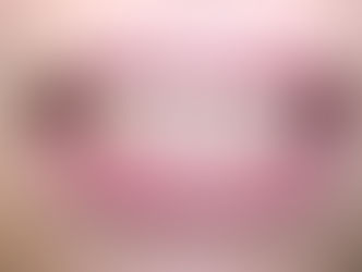 Nên làm gì để điều trị cho răng hết bị thưa?
