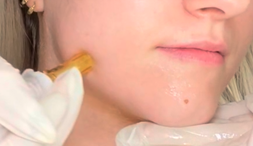 Close-up of a provider performing a facial treatment along a woman’s jawline using a handheld device.