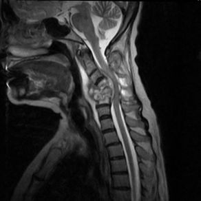 Case #5: об’ємний утвір на рівні C4-C6 хребців