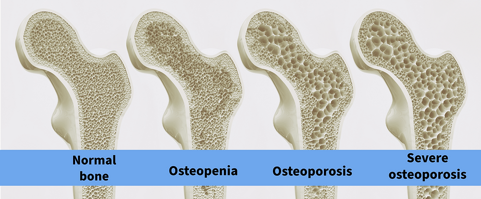 Bone Health and Osteoporosis