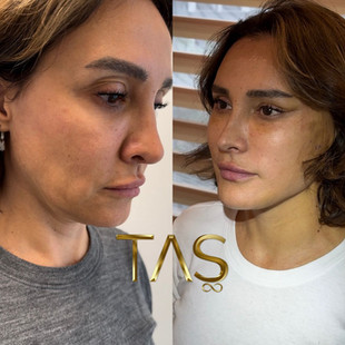 deeplane facelift, necklift, temporal lift