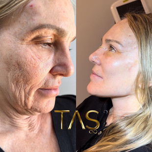 deeplane facelift, necklift, temporal lift, rhinoplasti