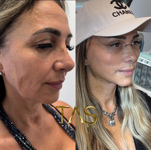deeplane facelift, necklift, temporal lift, rhinoplasti