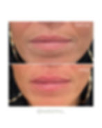 lip enhancement before and after