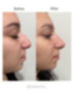 liquid nose job