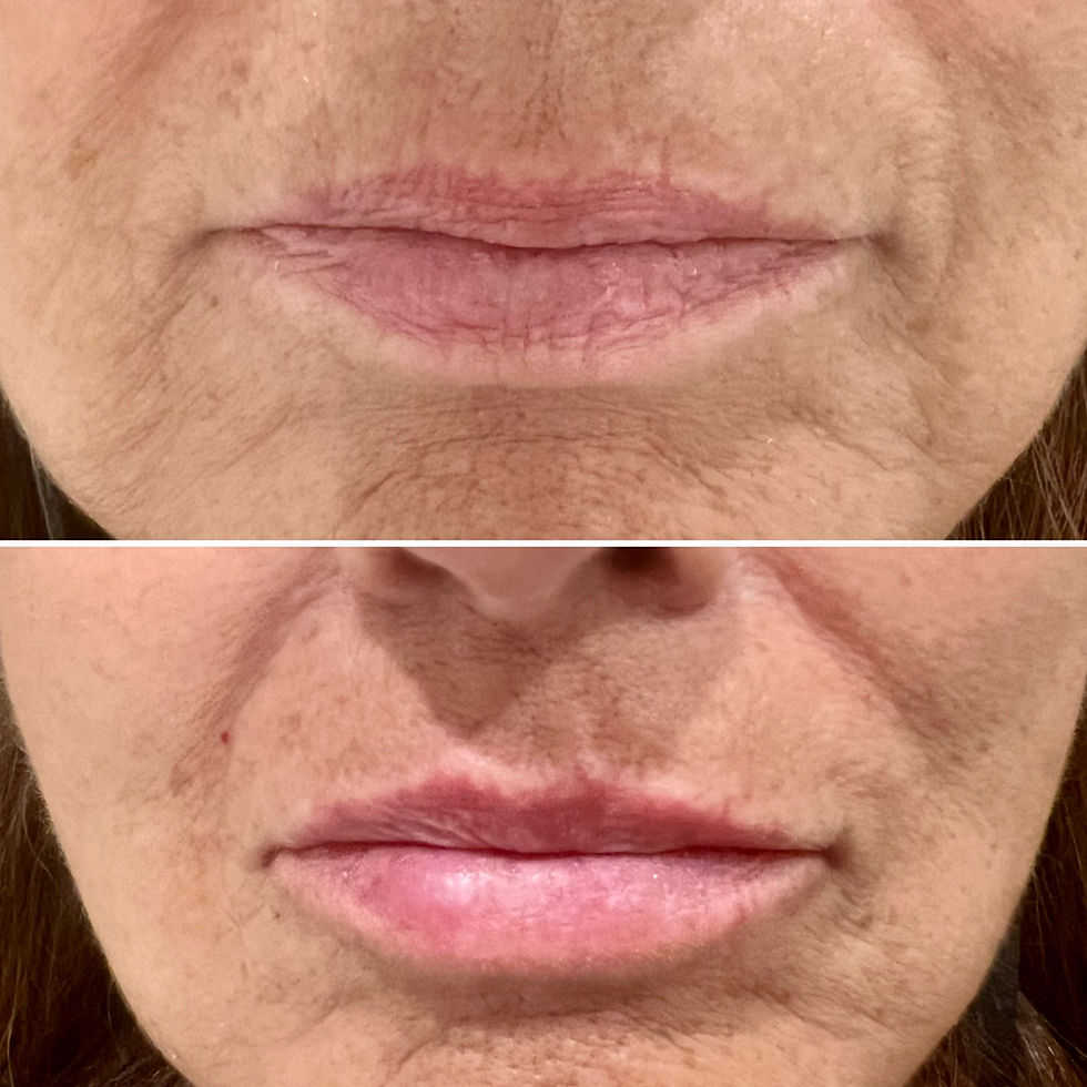 lip filler before and after