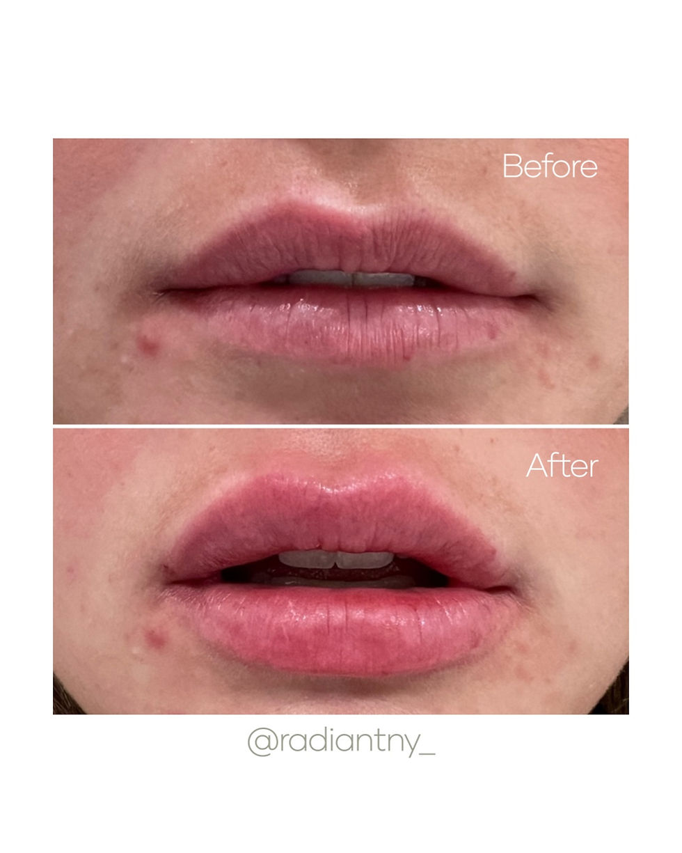 lip enhancement before and after
