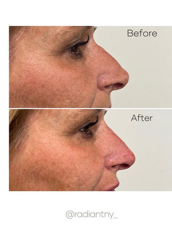 Liquid Rhinoplasty (dermal filler)