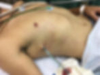 homem em posição supina com o hemitórax direito drenado