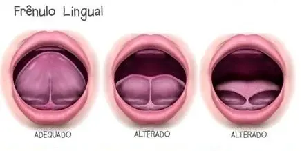 TESTE DA LINGUINHA PARA RECÉM NASCIDOS