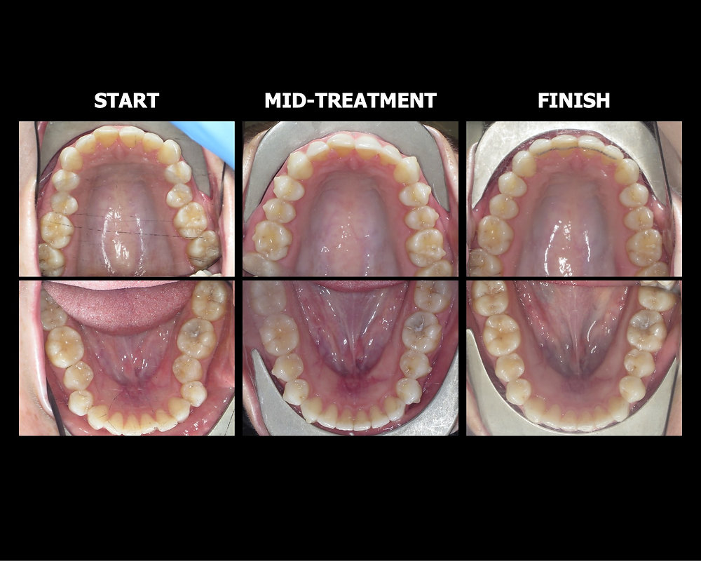 Moderate Case Aligners for Mild Cases