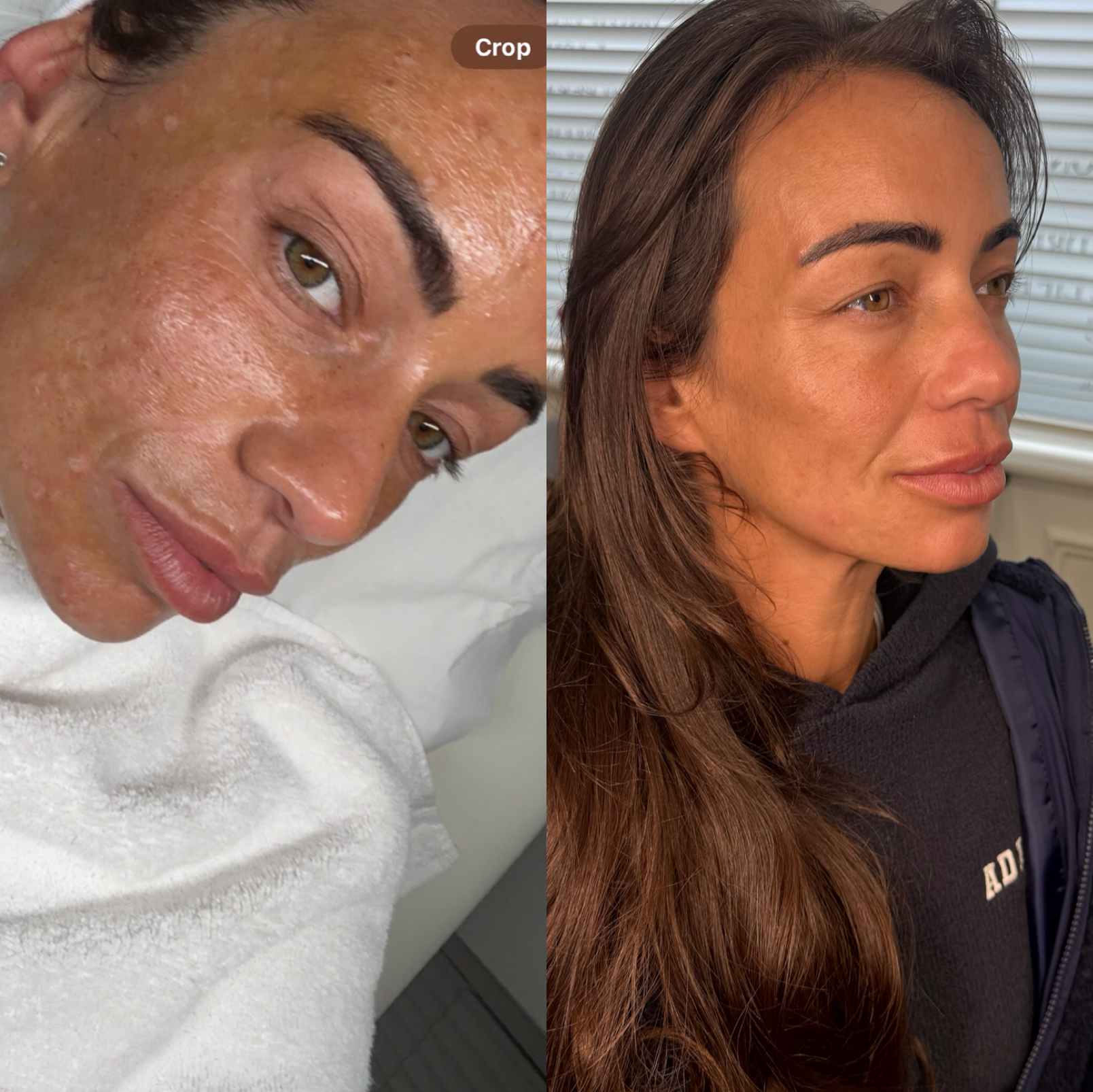 Microneedling Exosomes