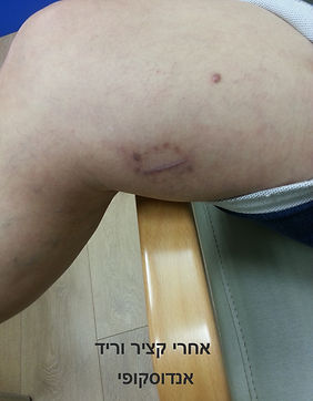 קציר וריד אנדוסקופי