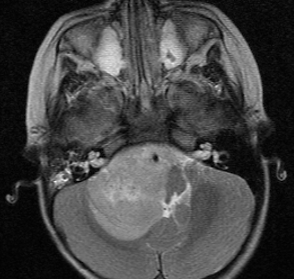 Title pic with caption... Anaplastic ependymoma.jpg