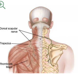 Dealing with Scapular Nerve Entrapment