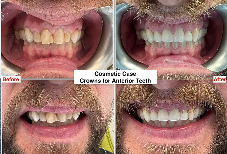 By replacing anterior fillings with custom crowns, this patient achieved a more natural and healthier smile with improved aesthetics.