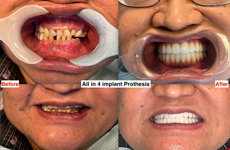 Tired of recurring dental visits for infections caused by gum disease and other issues, this patient opted for All-on-4 implants with a Zirconia prosthesis. The transformation resulted in a fully restored, functional, and stunning smile.
