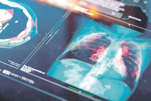 Estudio concluye que la contaminación del aire promueve el cáncer de pulmón en no fumadores
