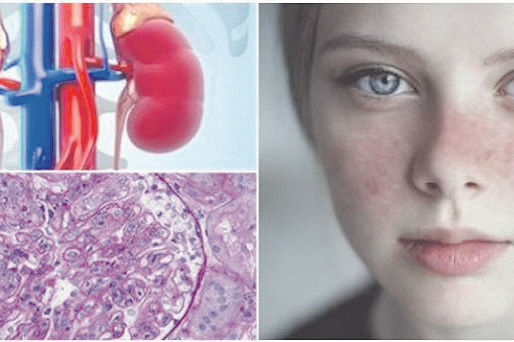 Casi la mitad de las personas con lupus reportan afectación renal